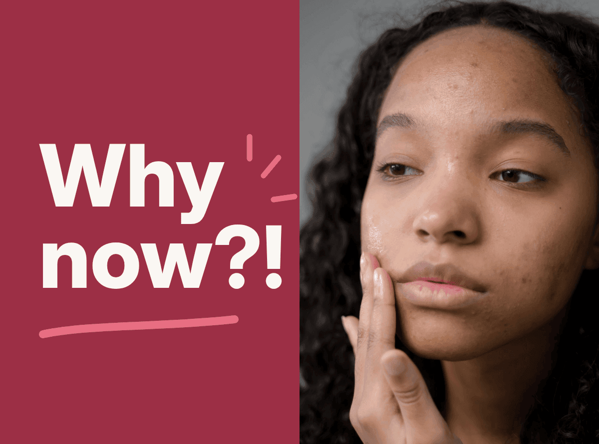 Young Black woman with curly hair touching her cheek, with a few small breakouts on her forehead, cheek and chin, next to the words "Why now?!"